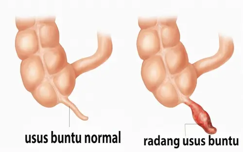 usus-buntu-radang
